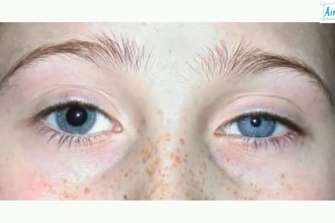 Anisocoria.jpg?format=webp