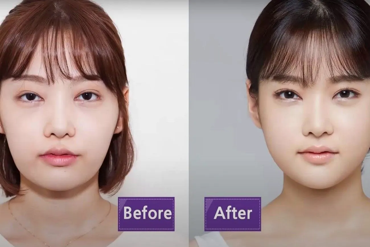 Cheek Reduction – South Korea.jpg?format=webp