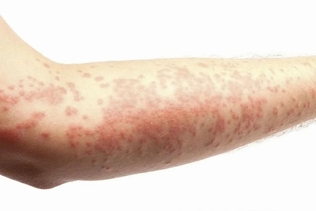 Cold Urticaria (Cold Hives).jpg?format=webp