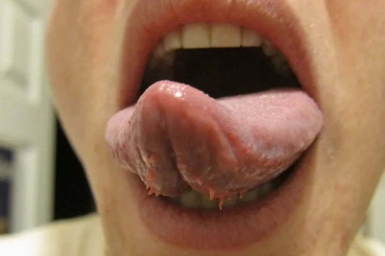 Fimbriated fold of tongue.jpg?format=webp