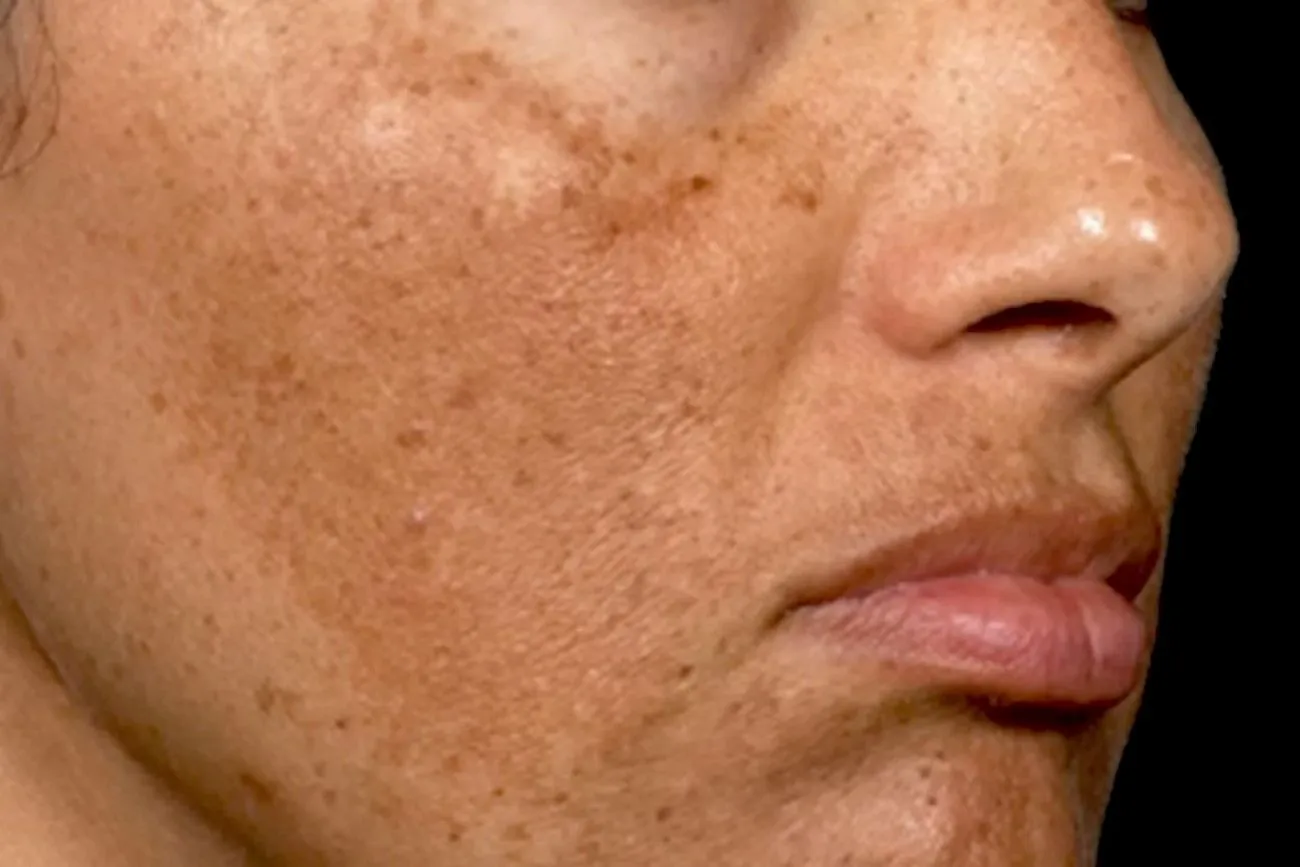 Hyperpigmentation or Melasma.jpg?format=webp