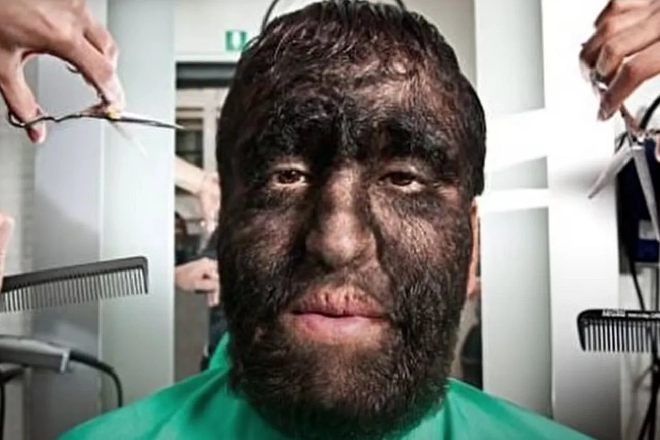 Hypertrichosis.jpg?format=webp